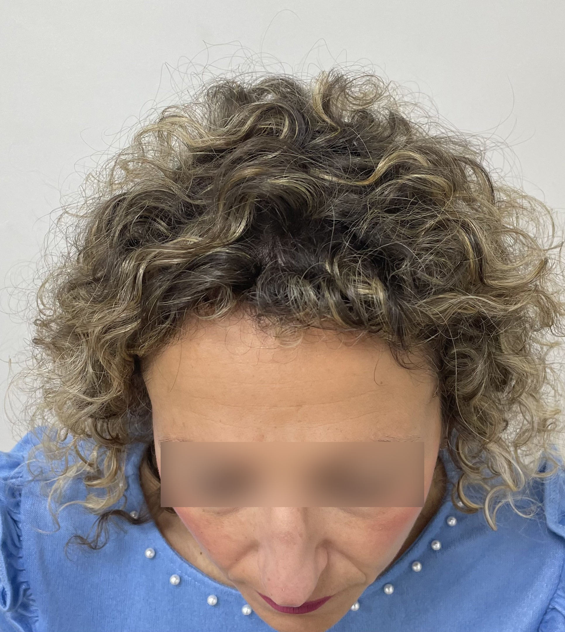 Antes Frontal Arriba