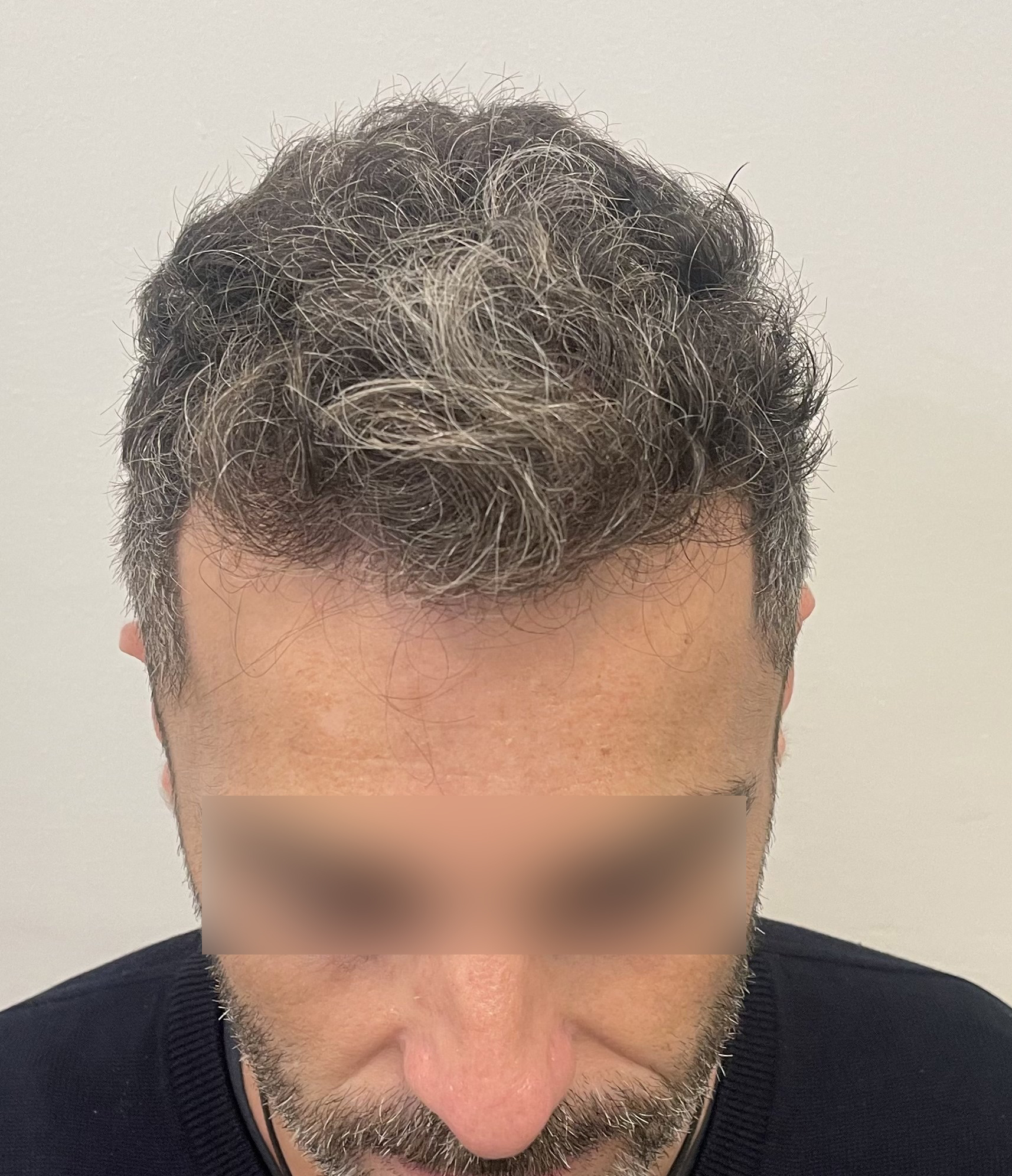 Antes Frontal Arriba